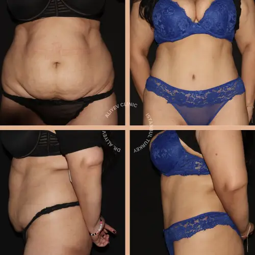 Abdominoplasty