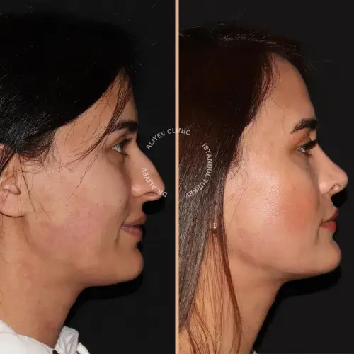 rhinoplasty-result10