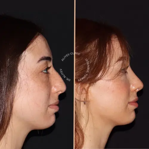 rhinoplasty-result2