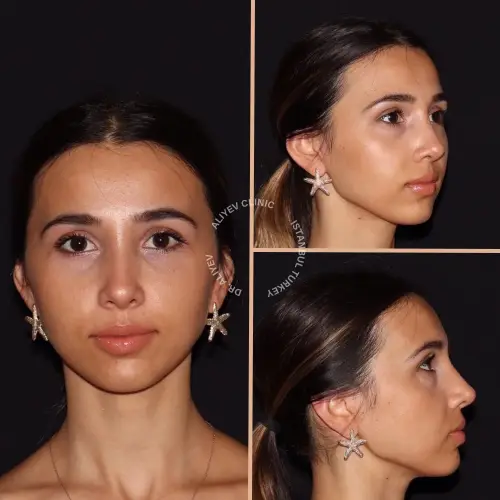 rhinoplasty-result6