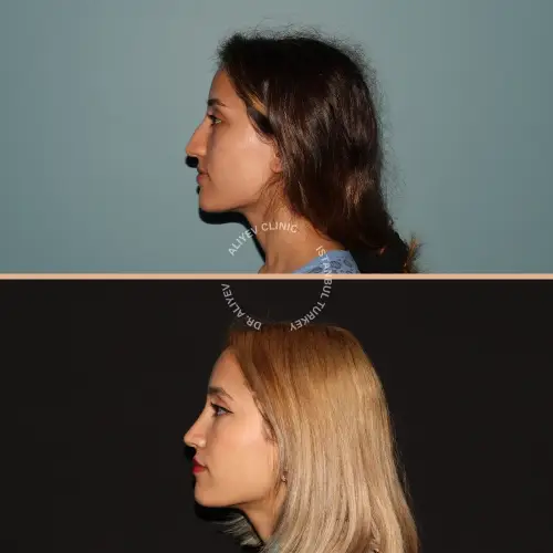 rhinoplasty-result8